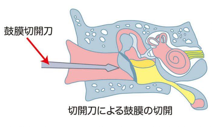 鼓膜切開術、鼓膜チューブ挿入術で生じる鼓膜の穴について