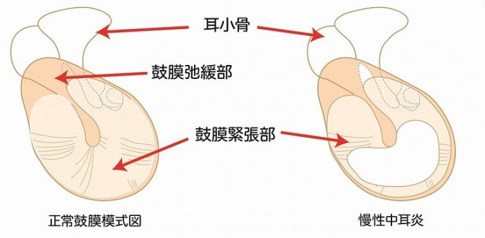 慢性化膿性中耳炎