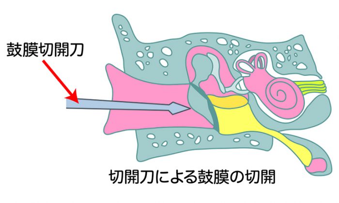 慢性中耳炎の治療法は？