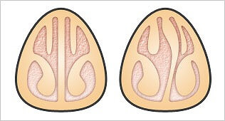 鼻づまりを引き起こす鼻中隔弯曲症