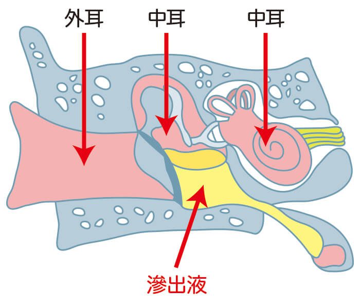 滲出性中耳炎になるのはなぜ？