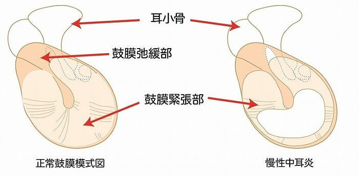 耳 詰まっ た 感じ 片方