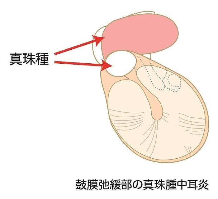 片方 の 耳 が 聞こえ にくい