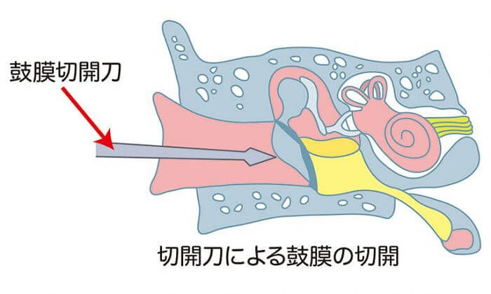 鼓膜切開術 日帰り 急性中耳炎 滲出性中耳炎の手術は大阪の こにし耳鼻咽喉科
