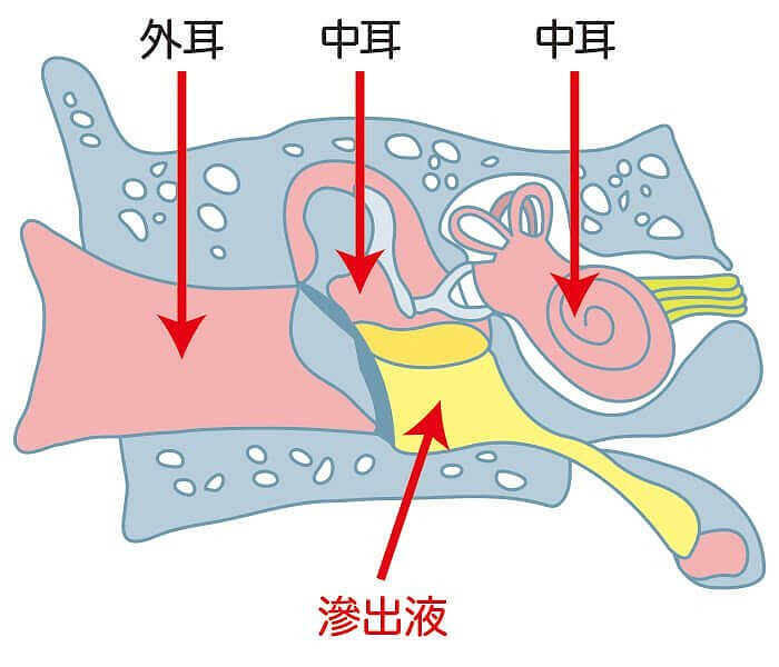 中耳炎ってどんな病気なの 中耳炎について大阪のこにし耳鼻咽喉科が詳しく解説